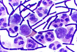 Bacillus anthracis (stained purple) growing in cerebrospinal fluid.