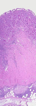 H and E section of colectomy showing transmural inflammation.
