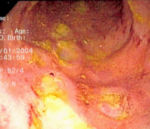 Endoscopic image of Crohn's colitis showing deep ulceration.