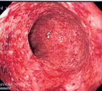 Crohn's disease can mimic ulcerative colitis on endoscopy.  This endoscopic image of is of Crohn's colitis showing diffuse loss of mucosal architecture, friability of mucosa in sigmoid colon and exudate on wall, all of which can be found with ulcerative colitis.
