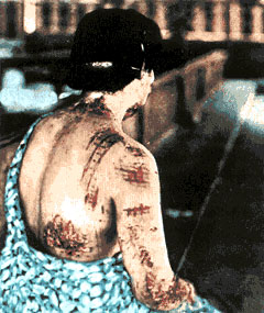 On this victim of the atomic bombing of Hiroshima, the pattern of the kimono is clearly visible as burns on the skin.