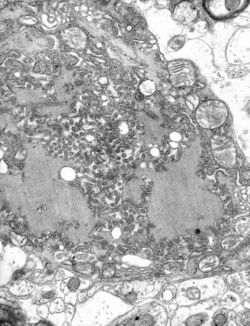 Micrograph with numerous rabies virions (small dark-grey rod-like particles) and Negri bodies, larger pathognomonic cellular inclusions  of rabies infection.