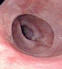 Endoscopic image of Schatzki ring, seen in the esophagus with the gastro-esophageal junction in the background.