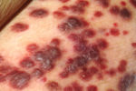 Kaposi's sarcoma