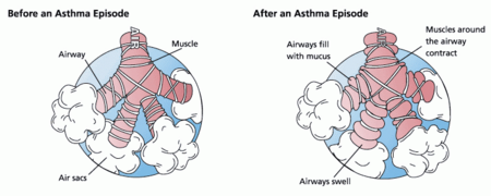 During an asthma episode, inflamed airways react to environmental triggers such as smoke, dust, or pollen. The airways narrow and produce excess mucus, making it difficult to breathe.