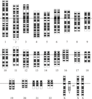 Karyotype for trisomy Down syndrome. Notice the three copies of chromosome 21.