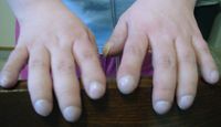 Clubbing - Patients with CF often have enlargement of their fingers, as shown here.