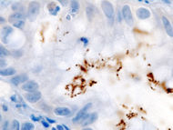 Immunohistochemical staining of  Helicobacter from a gastric biopsy.