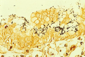 H. pylori colonized on the surface of regenerative epithelium (Warthin-Starry's silver)