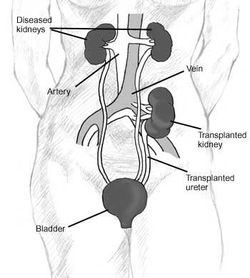 A diagram illustrating a typical kidney transplant such as the ones Woodruff performed in Edinburgh