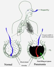 Pneumonia fills the lung's alveoli with fluid, keeping oxygen from reaching the bloodstream. The alveolus on the left is normal, while the alveolus on the right is full of fluid from pneumonia.