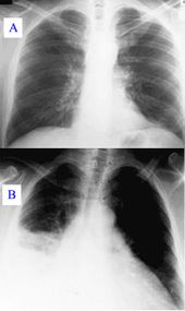 Pneumonia as seen on chest x-ray.  A: Normal chest x-ray. B: Abnormal chest x-ray with shadowing from pneumonia in the right lung (left side of image).