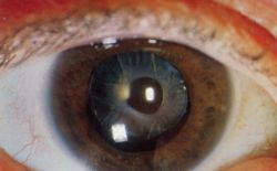 Slit lamp photo of Anterior capsular opacification visible few months after implantation of Intraocular lens in eye, magnified view