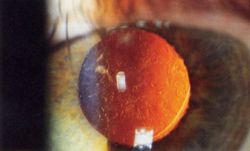 Slit lamp photo of Posterior capsular opacification visible few months after implantation of Intraocular lens in eye, seen on retroillumination