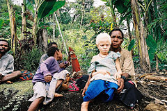 Albinistic girl from Papua New Guinea