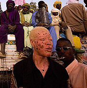 Albinistic man from Niger, with melanomas.