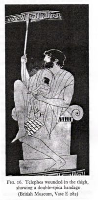 An ancient Greek treatment of a thigh injury. Use of a complex bandage can be seen.