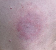 Bull's-eye-like rash caused by Lyme disease.