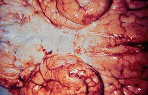 Interior view of a brain with meningitis caused by Haemophilus influenzae. Source: CDC