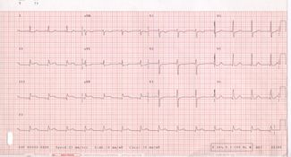 12-lead electrocardiogram (ECG) with ST-segment elevation in leads II, III and aVF, suggestive of an inferior acute myocardial infarction (AMI).
