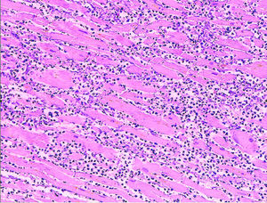 Microscopy image (magn. ca 100x, H&E stain) from autopsy specimen of myocardial infarct (7 days of duration).