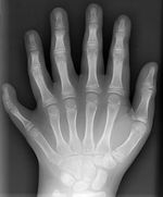 X-ray of the left hand of a ten year old boy with polydactyly